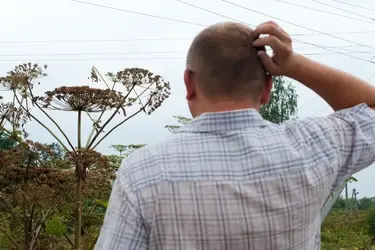 Ивановские врачи напомнили, что делать при ожоге борщевиком