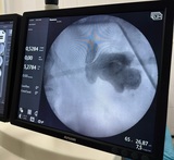 Уникальную операцию на почках провели в ивановской ГКБ № 7