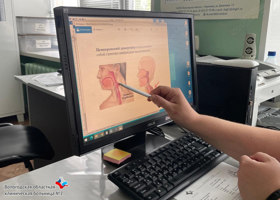 Благодаря застрявшей в горле кости у жительницы Вологодской области обнаружили серьёзное заболевание