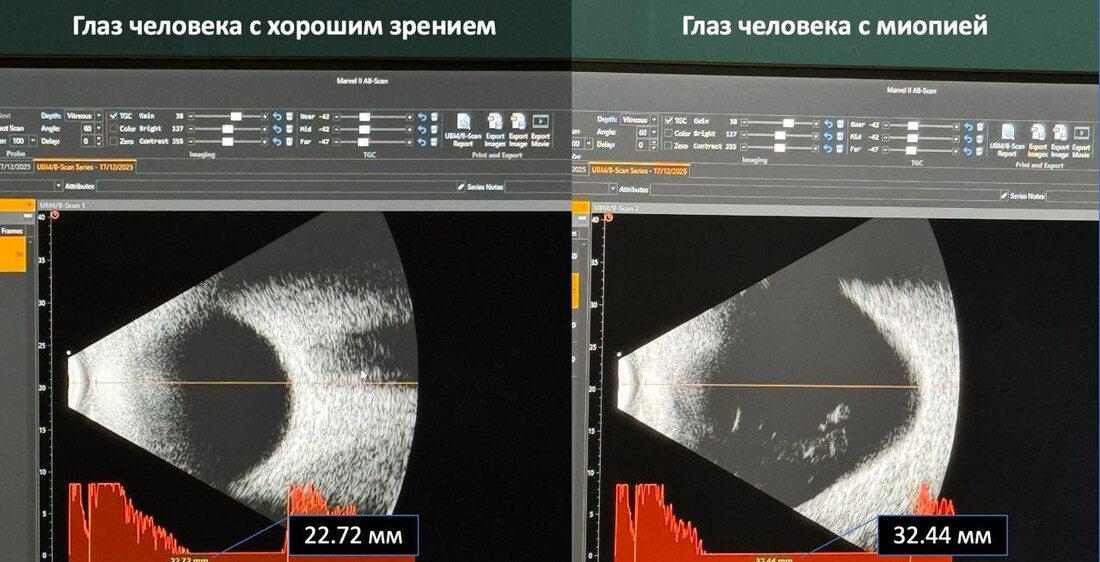 Вологодские врачи вернули зрение мужчине с высокой степенью близорукости
