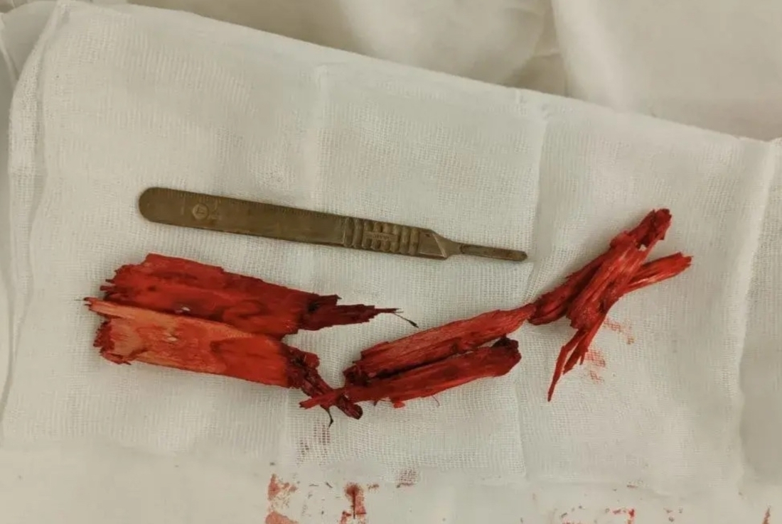 Врачи вытащили из носа вологжанина 10-сантиметровую щепку