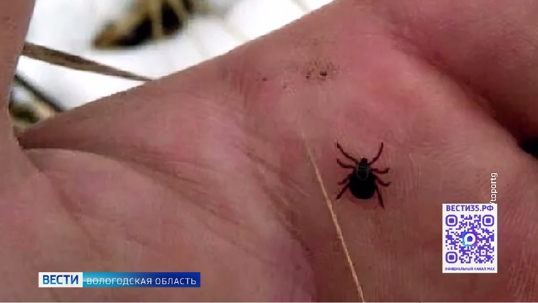 Мужчину с тяжёлой формой клещевого энцефалита спасли вологодские врачи