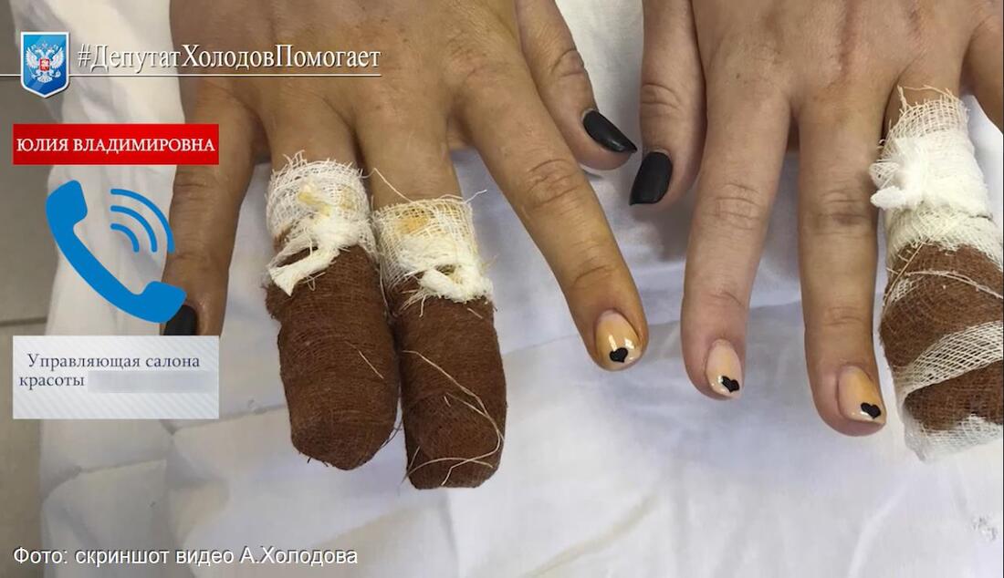 Опасные процедуры: 13-летняя вологжанка едва не осталась без пальцев