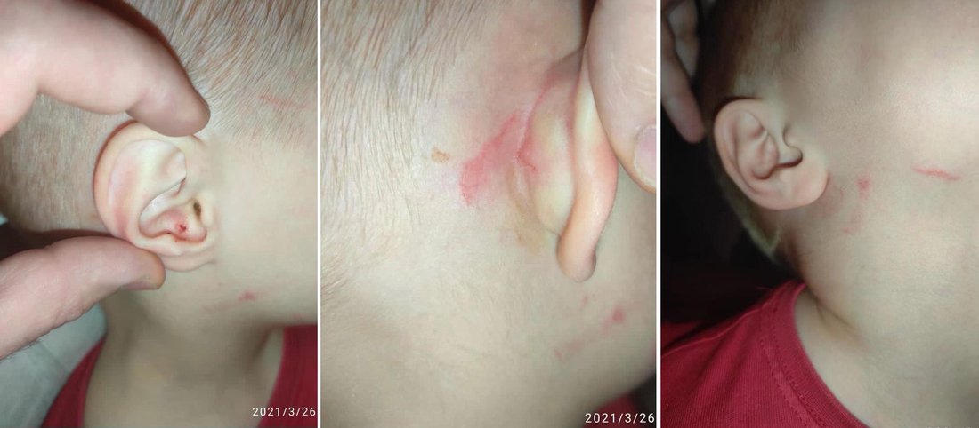 Воспитательница частного детсада Вологды расцарапала лицо трёхлетнему ребёнку